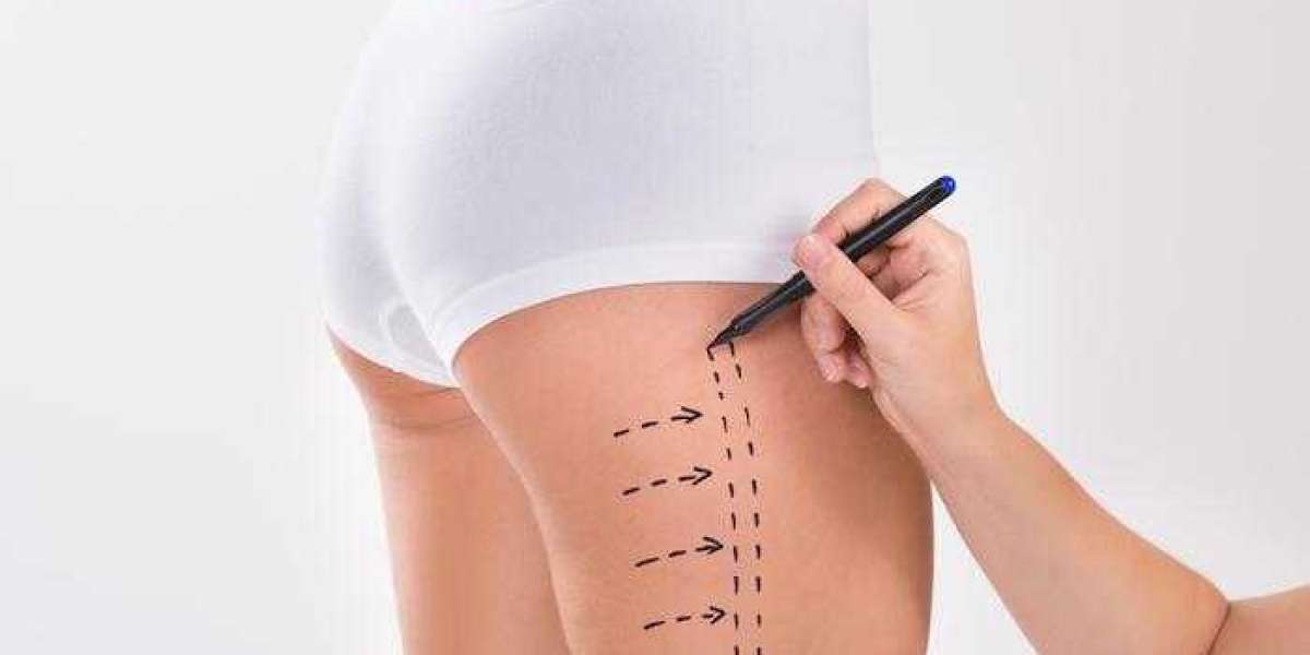 Liposuction in Dubai and Mental Wellbeing