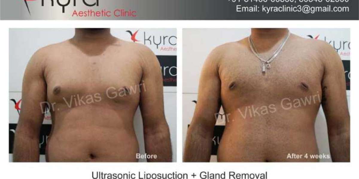 Male Chest Reduction Ludhiana: Transform Your Appearance with Kyra Clinic