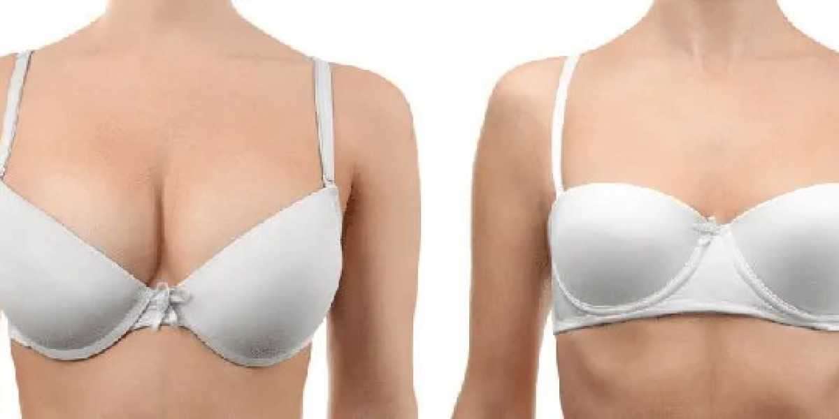 Pre-Operative Considerations for Breast Reduction