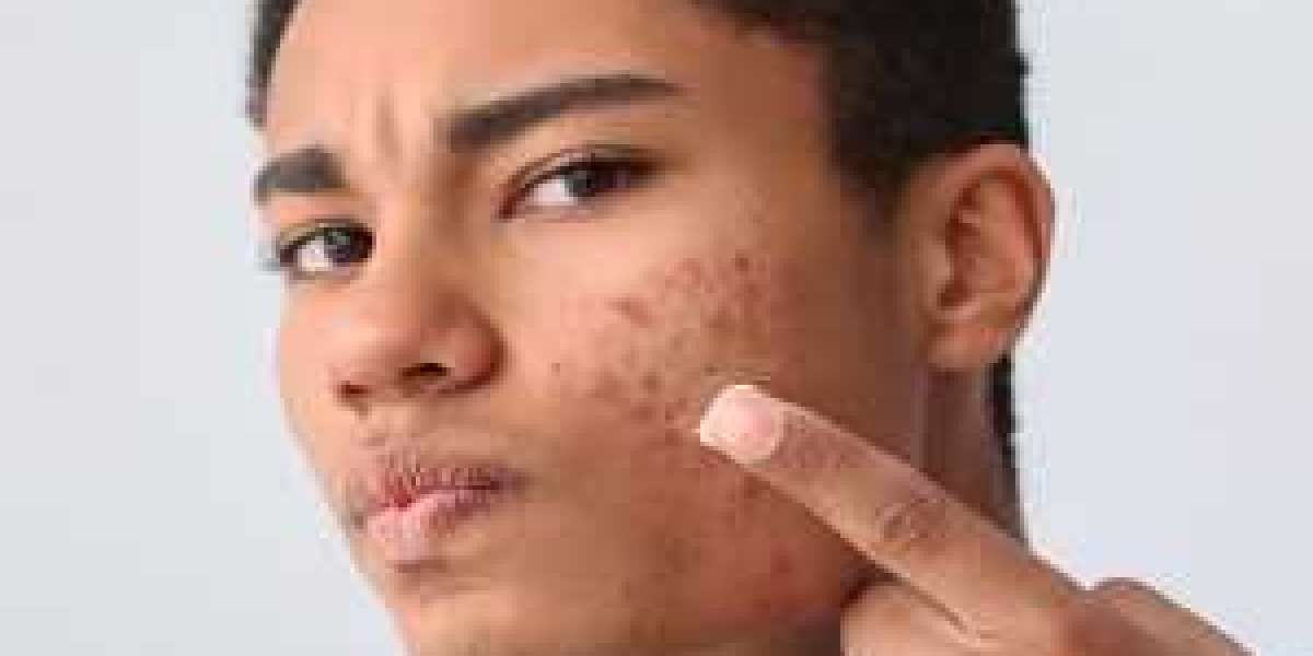 Best Moisturizers for Acne-Prone Skin