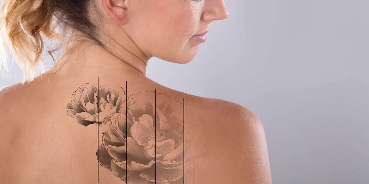 Can You Remove Tattoos While Pregnant or Breastfeeding?