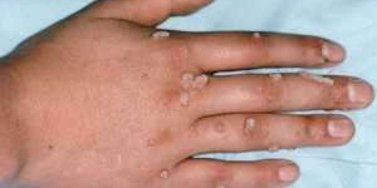 Top 3 Non-Surgical Warts Removal Methods in Islamabad