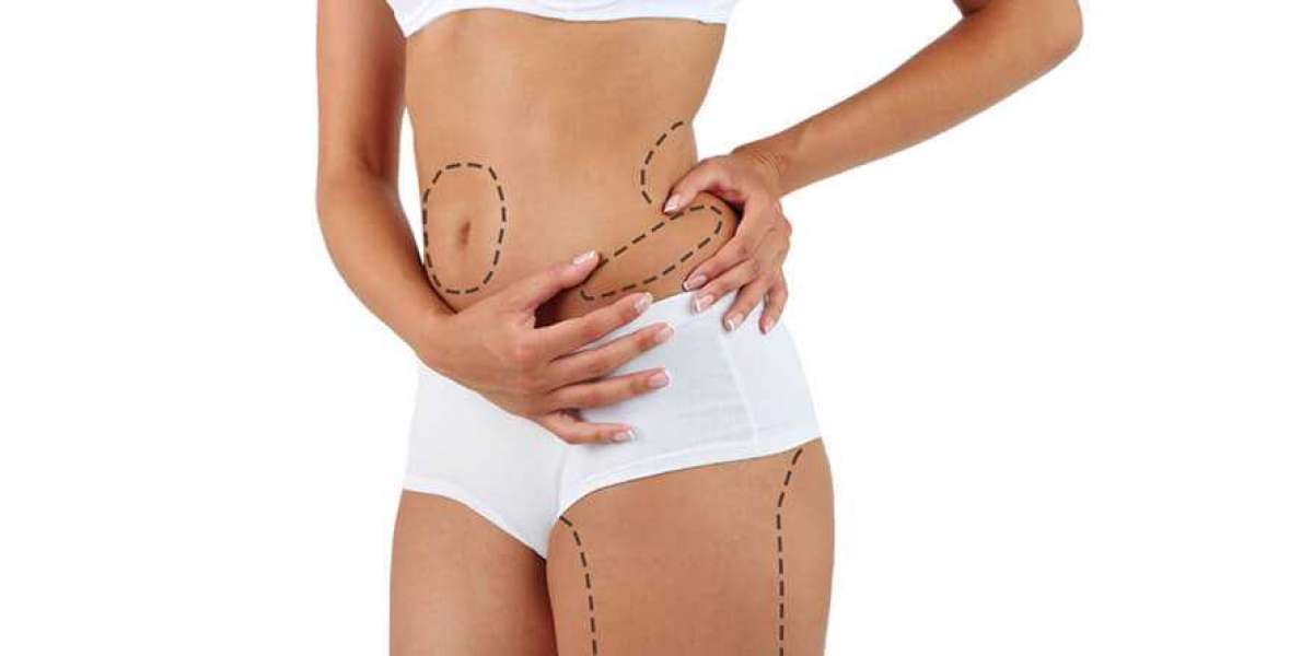 Liposuction for Fat Removal: Popular Trends in Islamabad Clinics