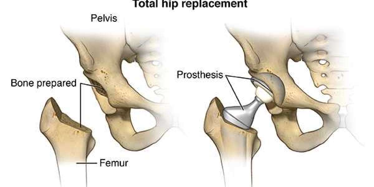 Hip Replacement Surgery: A Patient's Perspective